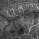 Branch Retinal Vein Occulsion Branch Retinal Vein Occulsion